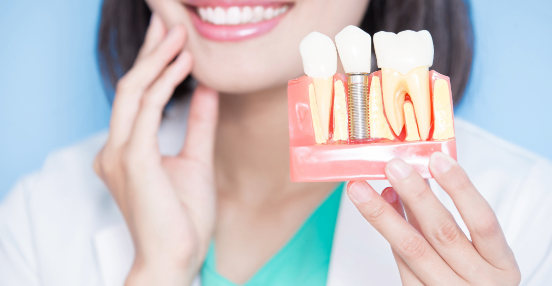 Dental Implants In Miami Lakes Florida